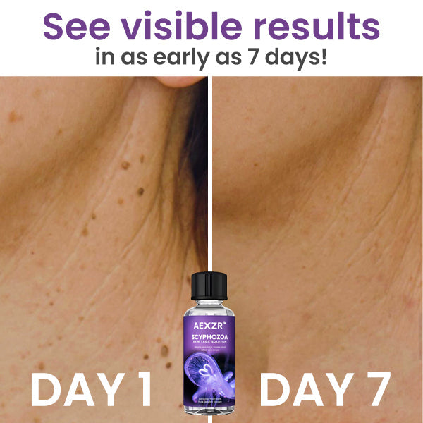 AEXZR™ Scyphozoa Skin Tags Solution - 👩‍⚕️ Recommended by Experts 💥 80% Limited Discounts 🎉