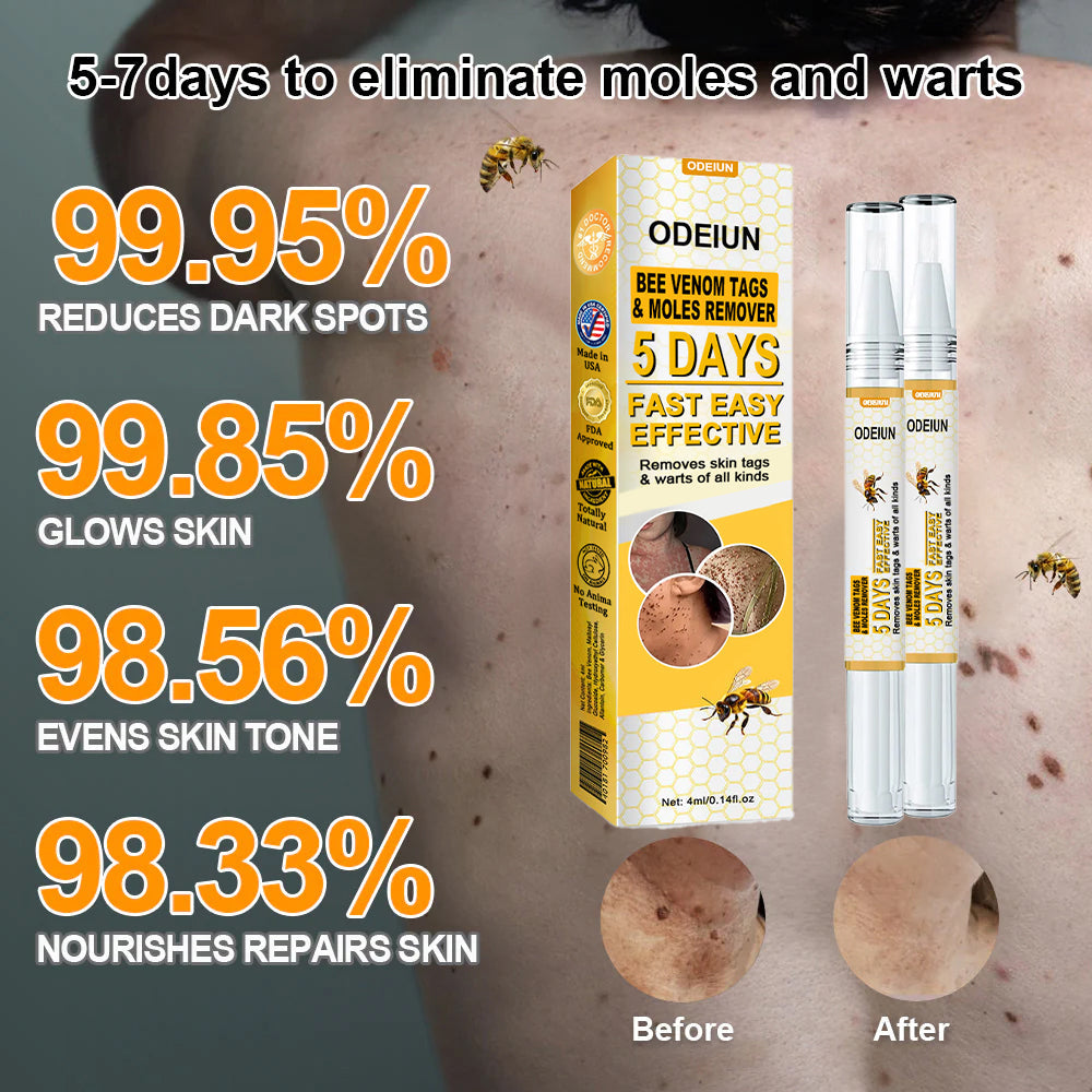 🌿🌿[✨𝐎𝐟𝐟𝐢𝐜𝐢𝐚𝐥 𝐁𝐫𝐚𝐧𝐝 𝐒𝐭𝐨𝐫𝐞✨] ODEIUN™ Bee Venom Tags & Moles Remover(👨‍⚕𝐀𝐀𝐃 𝐑𝐄𝐂𝐎𝐌𝐌𝐄𝐍𝐃𝐒)