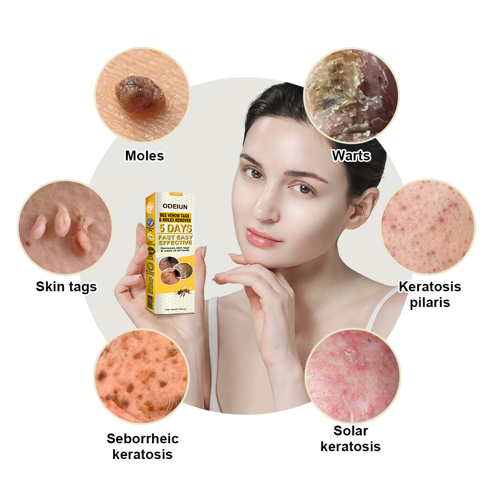 🌿🌿[✨𝐎𝐟𝐟𝐢𝐜𝐢𝐚𝐥 𝐁𝐫𝐚𝐧𝐝 𝐒𝐭𝐨𝐫𝐞✨] ODEIUN™ Bee Venom Tags & Moles Remover(👨‍⚕𝐀𝐀𝐃 𝐑𝐄𝐂𝐎𝐌𝐌𝐄𝐍𝐃𝐒)