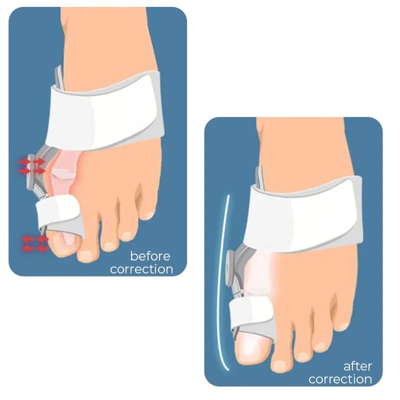 JointTech Anti Bunion Adjustable Corrector