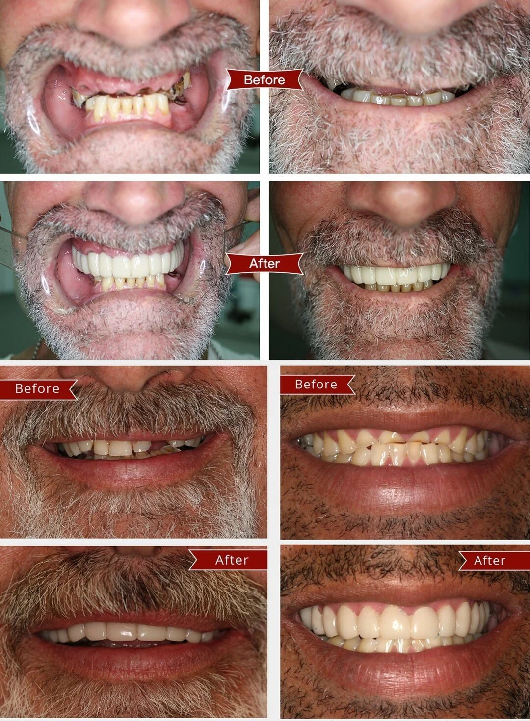 🔥Last Day 50% OFF🔥American Smile Veneers